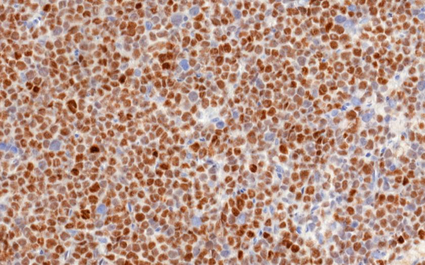 Kuvassa valomikroskooppikuva imukudossyöpäkudoksesta, jossa syöpäsolut ilmentävät MYC -proteiinia (ruskea väri). Kuva Leppä lab. 