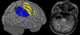 Epilepsiakirurgian tietokoneohjelman tuottamia kuvia. Vasemmalla aivokuori, sen alueita ja asennetut elektrodit. Oikealla magneettikuvaleike ja siihen yhdistettyjä elektrodeja. 