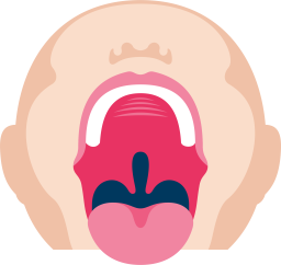 Pehmeän_suulaen_halkio