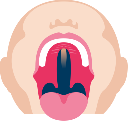 Pehmeän_ja_kovan_suulaen_halkio