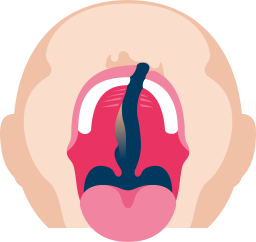 Toispuoleinen_huuli_ja_suulakihalkio