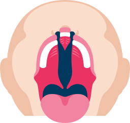 Molemminpuoleinen_huuli_suulakihalkio