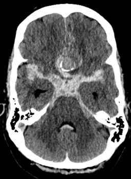 Vuotava aneurysma TT-kuvassa